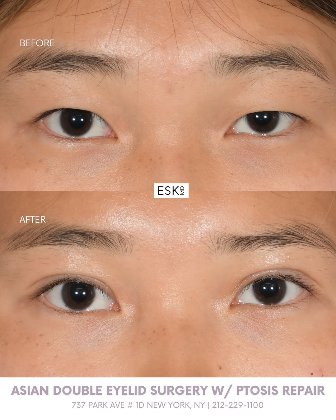 Instagram post by Dr. Edward S. Kwak: Phenomenal results just 1️⃣ month post-op! 📍 737 Park Ave 1D 📞 212-229-1100 . . . #ESKMD #NYCPlasticSurgery #NYCPlasticSurgeon #PtosisRepa…
