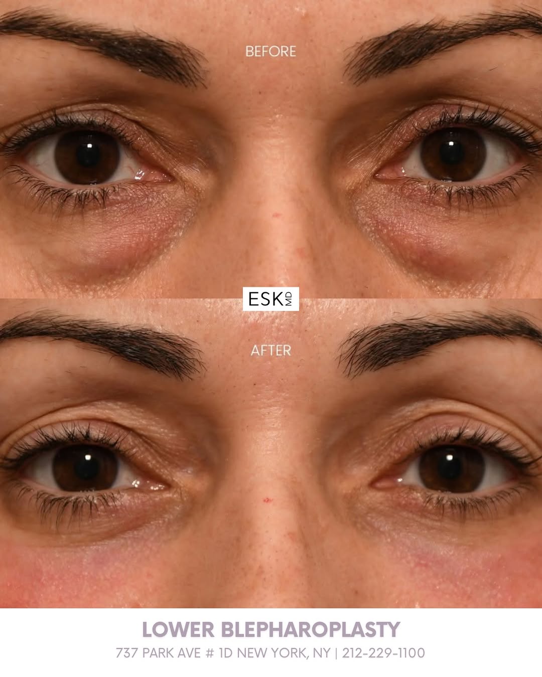 Instagram post by Dr. Edward S. Kwak: A refreshed appearance often starts with the eyes. By refining the under-eye contour, lower blepharoplasty creates a brighter, fresher appea…