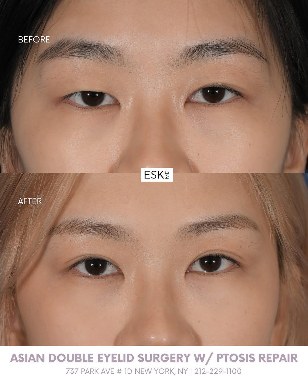 Instagram post by Dr. Edward S. Kwak: This double eyelid surgery and ptosis repair combination improved eyelid definition and created a more open and balanced appearance to the e…