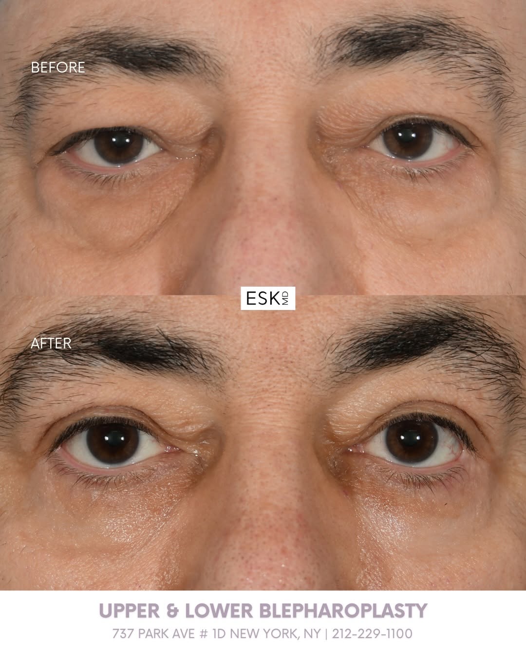 Instagram post by Dr. Edward S. Kwak: A more refreshed look from every angle 🤩. A combination upper and lower blepharoplasty helps reduce heaviness and under-eye bags to create …
