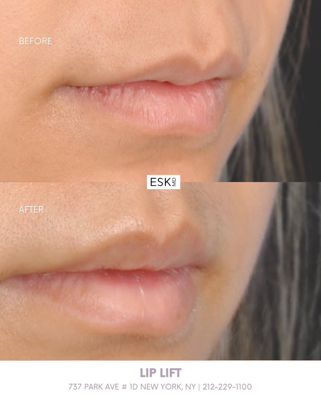 Instagram post by Dr. Edward S. Kwak: Sometimes the smallest change creates the most impact. With a lip lift, Dr.Kwak create a fuller upper lip and shortened philtrum length whil…