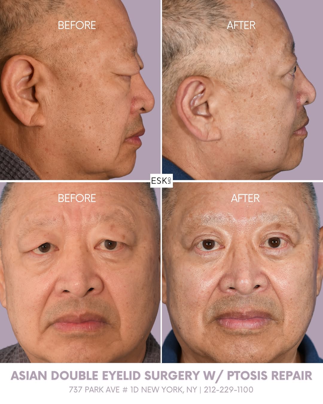 Instagram post by Dr. Edward S. Kwak: Asian double eyelid surgery with ptosis repair can create a remarkable change in how open, alert, and refreshed the eyes appear. The result …