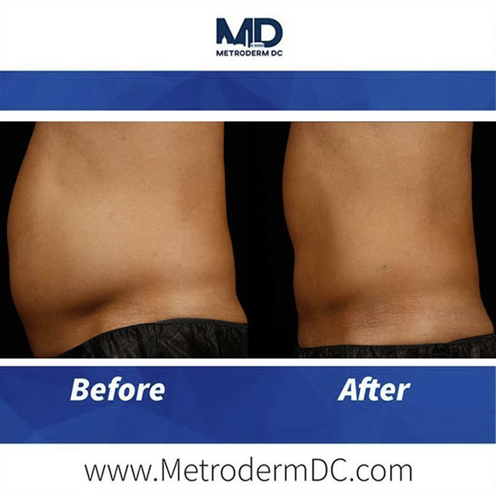 Instagram post by Dr. Edward Stolar: Before & After: BODY CONTOURING www.metrodermdc.com