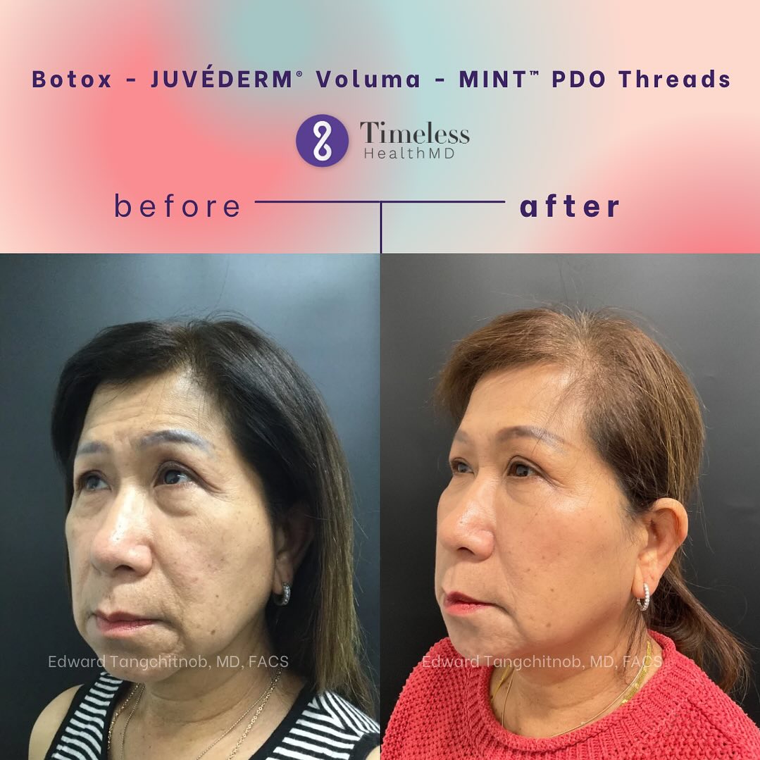 Instagram post by Dr. Edward Tangchitnob: Injectables administered by professionals can replenish lost volume and enhance your features, achieving a subtle and natural-looking restor…