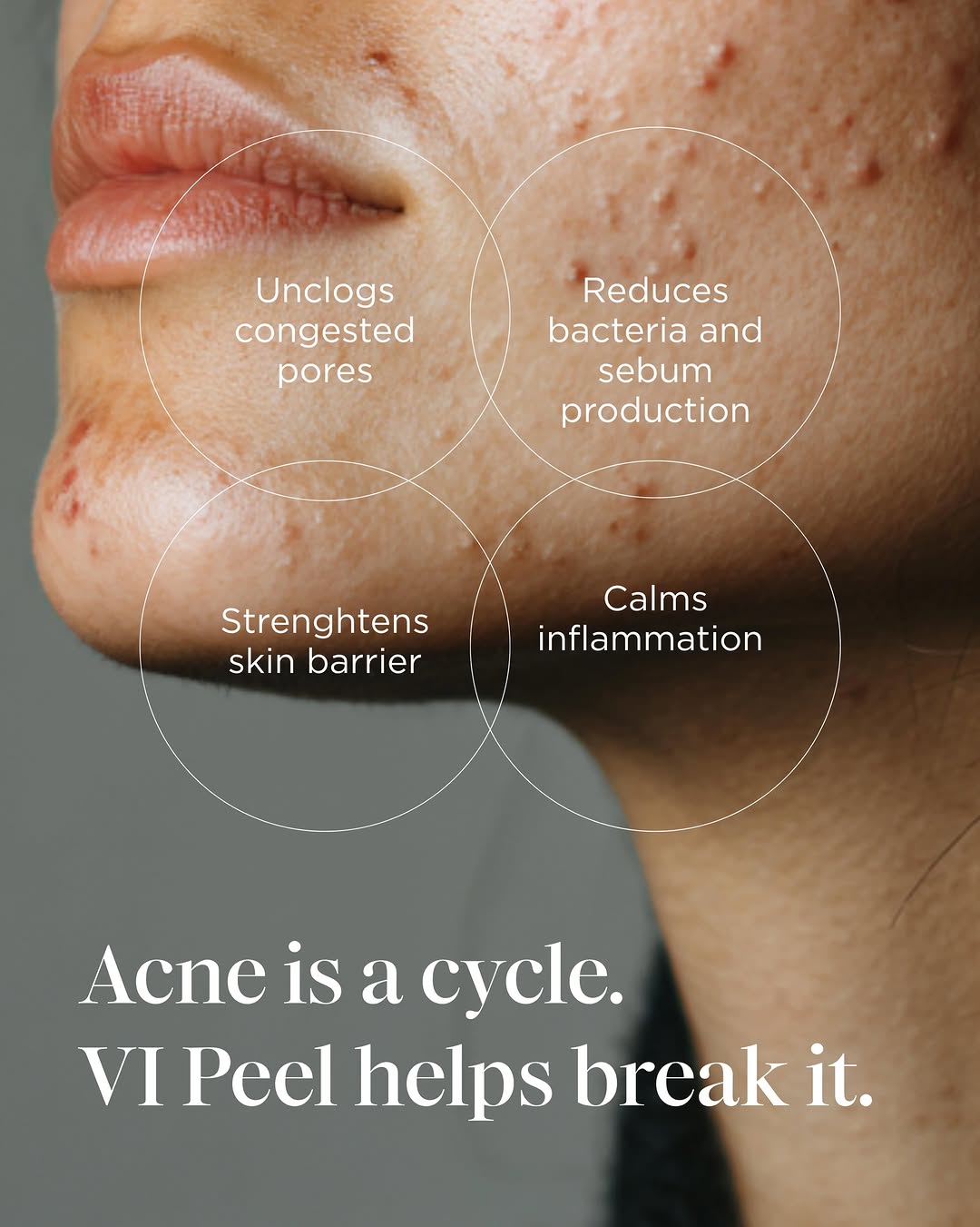 Instagram post by Dr. Edwin C. Pound, III: ✨ Acne can affect more than just your skin—it can impact confidence, self-esteem, and overall skin health. 💙 This Acne Awareness Month, we'…