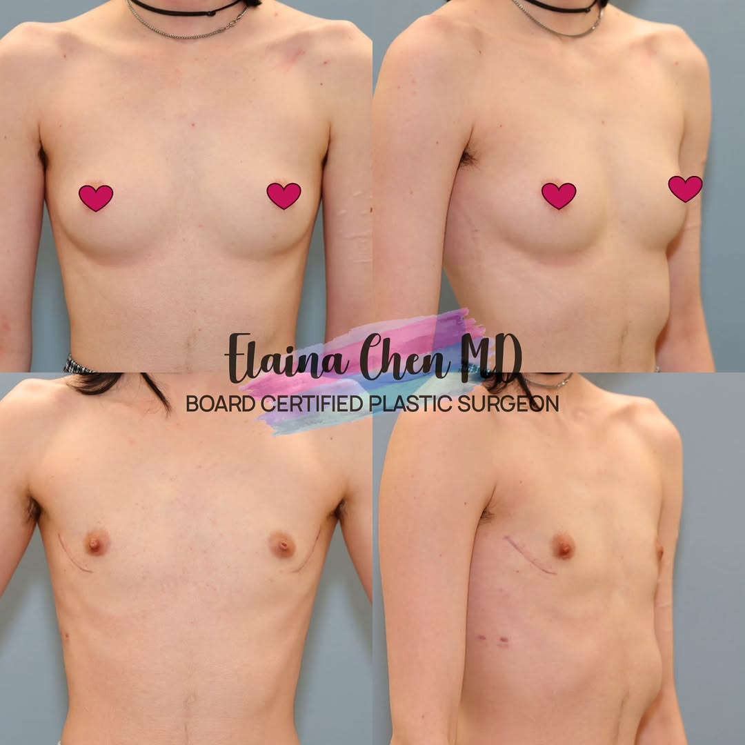 Instagram post by Dr. Elaina Chen: It's Transformation Thursday! For select trans/nb patients wanting a masculine chest, a single incision strategically placed in the lateral …