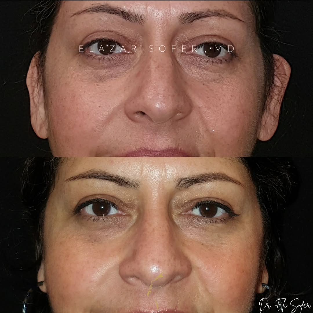 Instagram post by Dr. Elazar Sofer: Earpinning | 1yr PostOp . This lovely woman felt her ears were sticking out too much. . We performed an earpinning surgery by simply numbing…