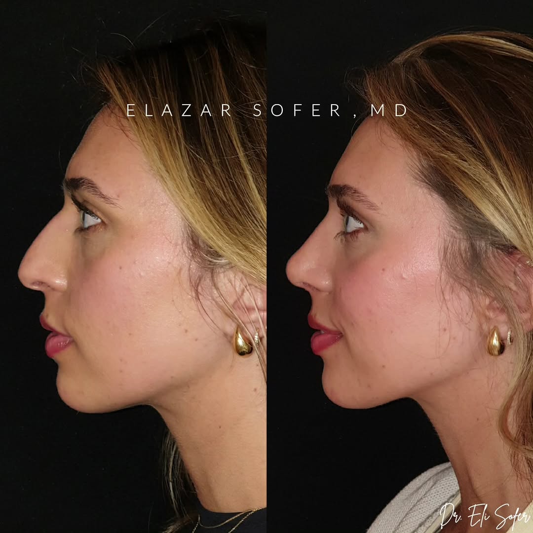 Instagram post by Dr. Elazar Sofer: SeptoRhinoplasty | 3mos PostOp . This beautiful young lady wanted to refune her nose. She wanted a natural result. . Here she is at 3mos pos…