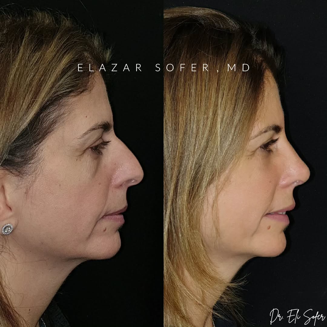 Instagram post by Dr. Elazar Sofer: What Make-Up couldn't fix! . My lovely patient wanted to treat the bags under her eyes and the bump on her bridge. She avoided certain camer…