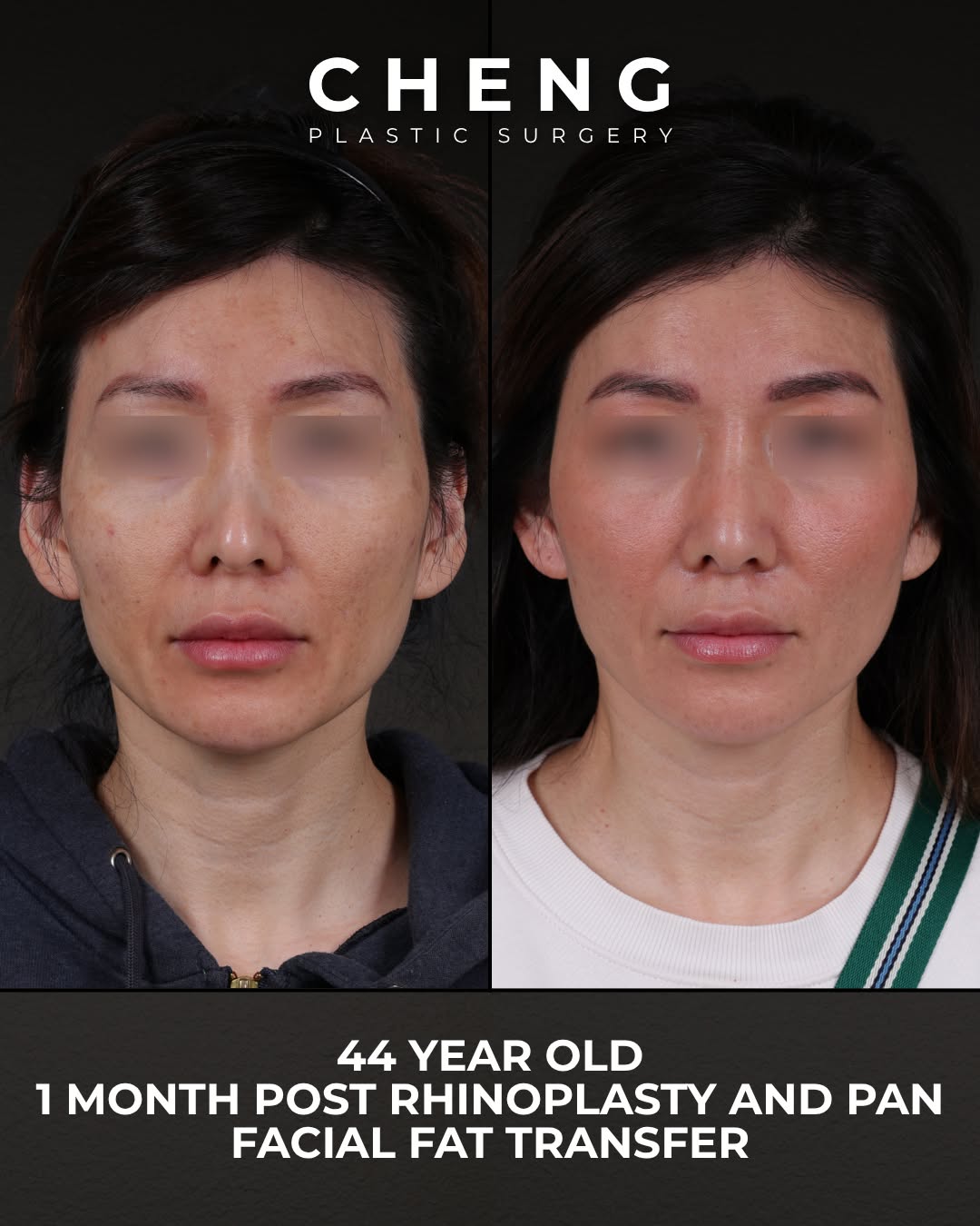 Instagram post by Dr. Elbert T. Cheng: This patient came to Dr. Jacqueline Cheng more than 15 years after undergoing a rhinoplasty elsewhere. Over time, she continued to feel that…