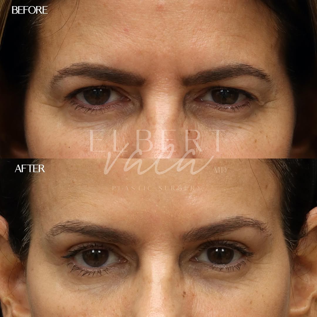Instagram post by Dr. Elbert Vaca: #browlift + #upperblepharoplasty 3 months after surgery Browlift & upper #eyelidsurgery - the perfect combination to restore a more youthful…