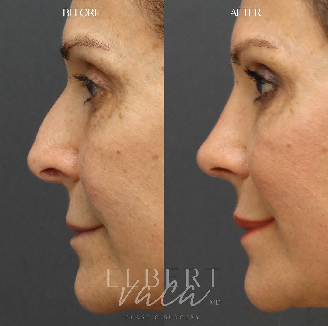 Instagram post by Dr. Elbert Vaca: Rhinoplasty ✨ An update on this patient’s beautiful & elegant #rhinoplasty result 2 months after surgery. ✅ droopy tip corrected 🚫dorsal hu…