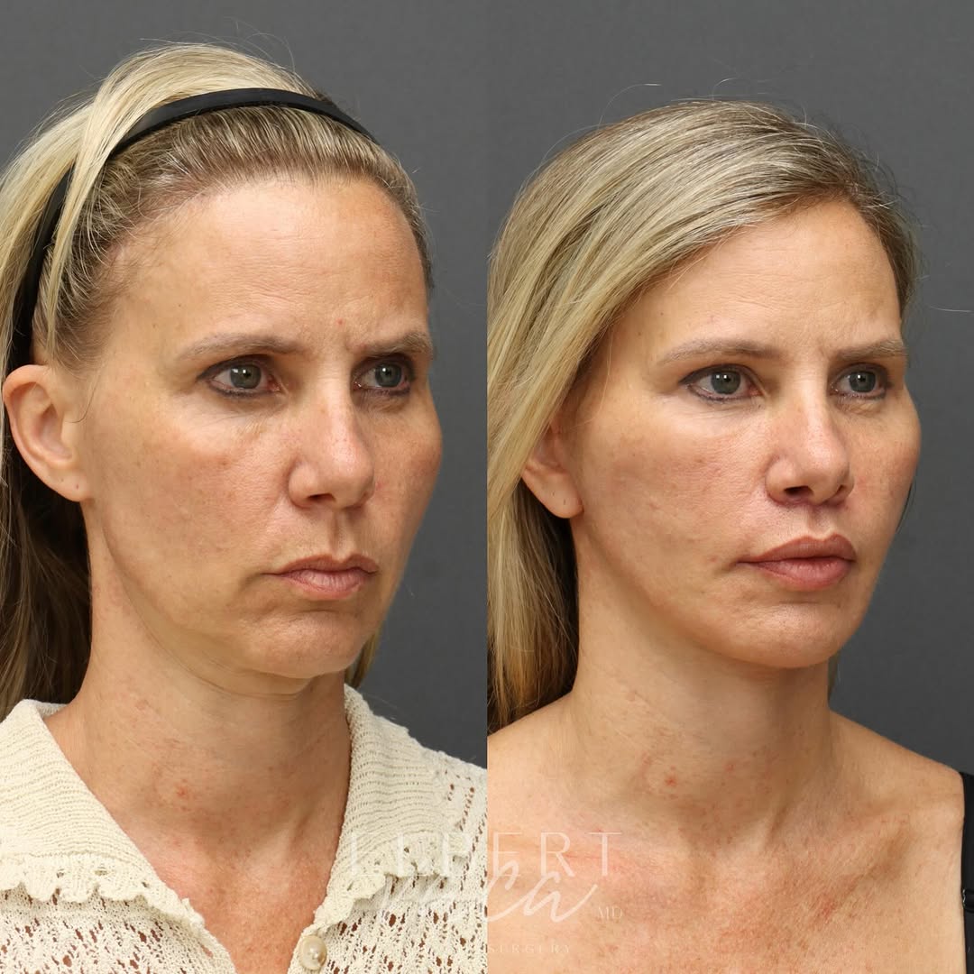 Instagram post by Dr. Elbert Vaca: This beautiful patient in her early 50s is just 17 days out from: ✨ Face & Necklift ✨ Facial fat grafting ✨ Lip lift The combination of thes…