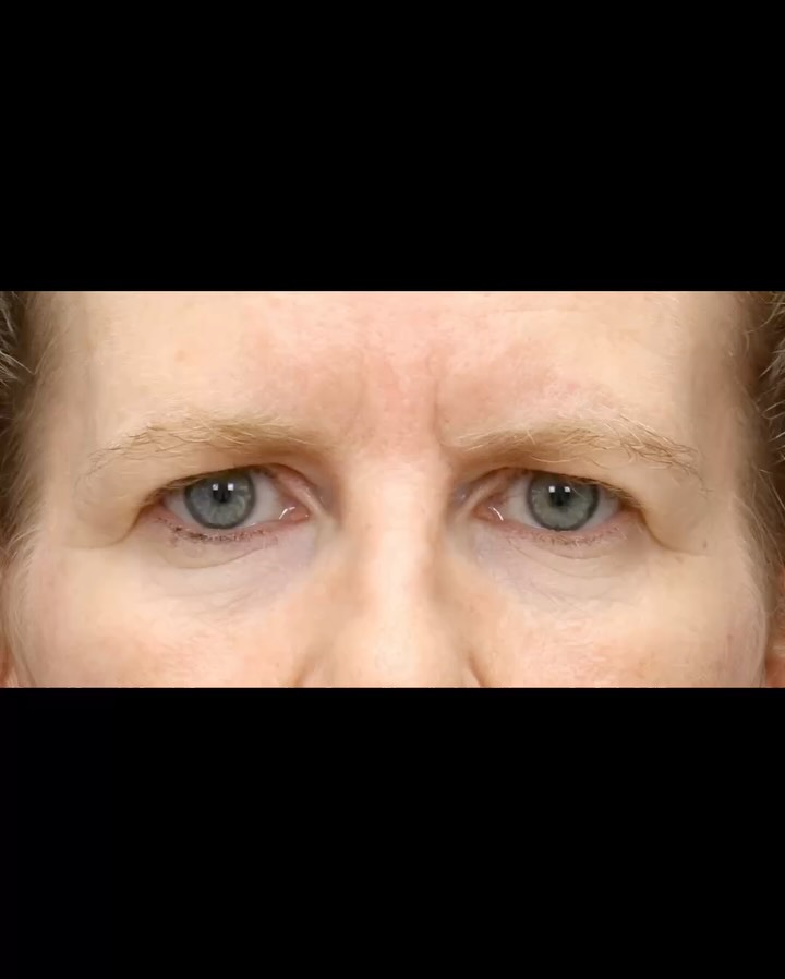 Instagram post by Dr. Elbert Vaca: ✨ A subtle transformation can make a remarkable difference. This patient’s refreshed, brighter appearance was achieved by combining a brow l…