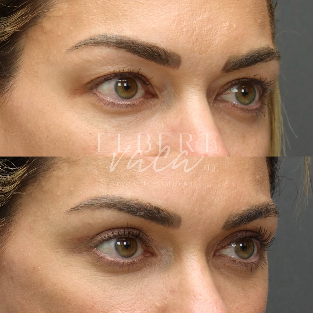 Instagram post by Dr. Elbert Vaca: Upper #blepharoplasty ✨ This beautiful patient in her 40s is looking fantastic at only 6 weeks after surgery. While upper blepharoplasty may…
