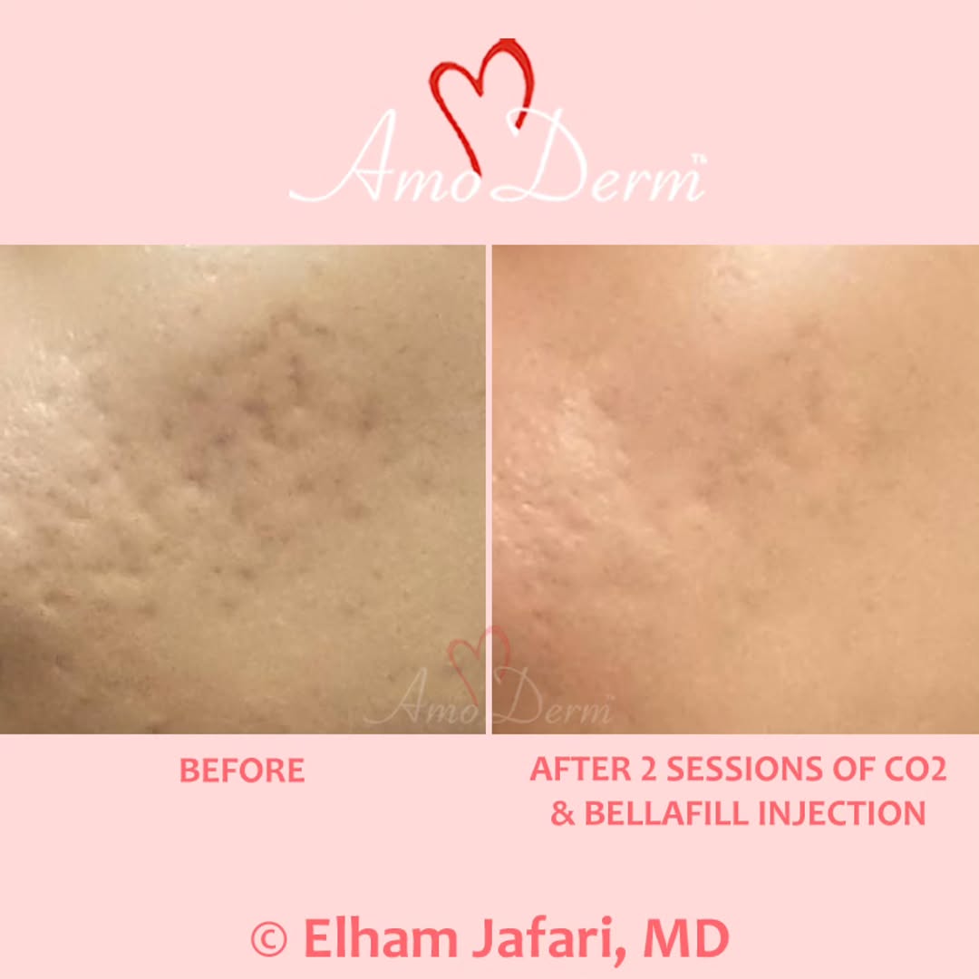 Instagram post by Dr. Elham Jafari: π Treatment of Acne Scars ____ π Treatment Options: Several options are available: BellaFill is an FDA-approved filler that is injected toβ¦