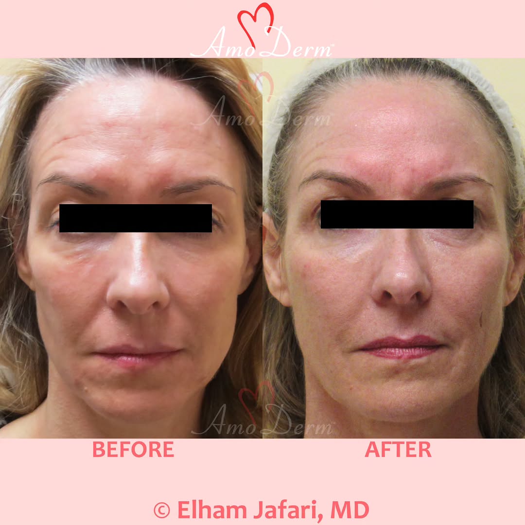 Instagram post by Dr. Elham Jafari: π Non-surgical facelift (Liquid Facelift) ____ π Procedure: Injection of dermal fillers in cheeks, under eyes & nasolabial folds (laugh liβ¦
