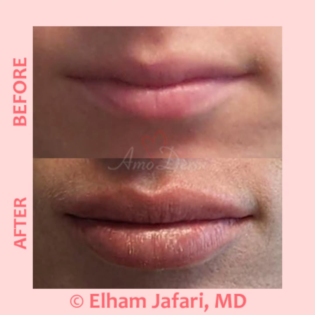Instagram post by Dr. Elham Jafari: π Lip augmentation and enhancement π ___ π Procedure: Dermal filler injection in lips by experienced MD ___ π― Purpose: Adding volume to β¦