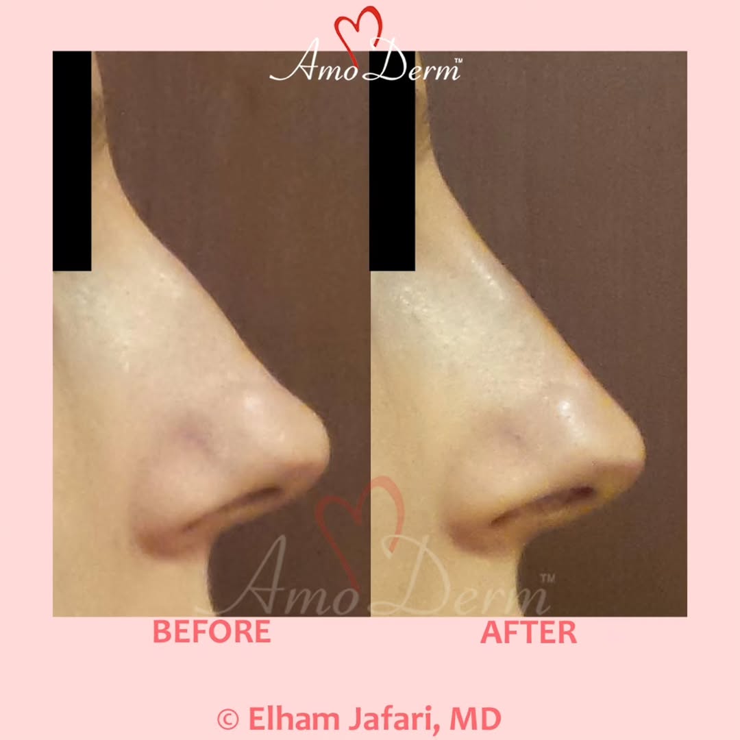 Instagram post by Dr. Elham Jafari: βπ¨ Non-surgical nose job (liquid rhinoplasty) to correct nose deviation, nose bumps or humps and sculpting and reconstructing nose bridge wβ¦