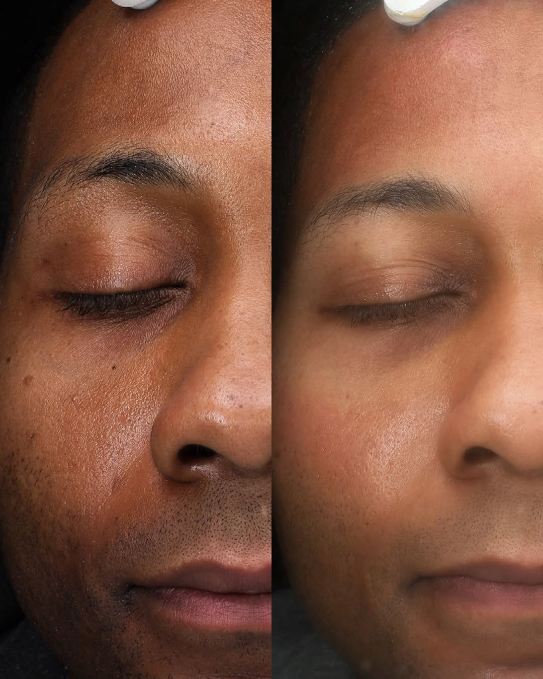 Instagram post by Dr. Eliot Battle: Complexion Blending™ is a gentle, non-invasive laser treatment created to improve the overall appearance of uneven skin tone. The treatment …