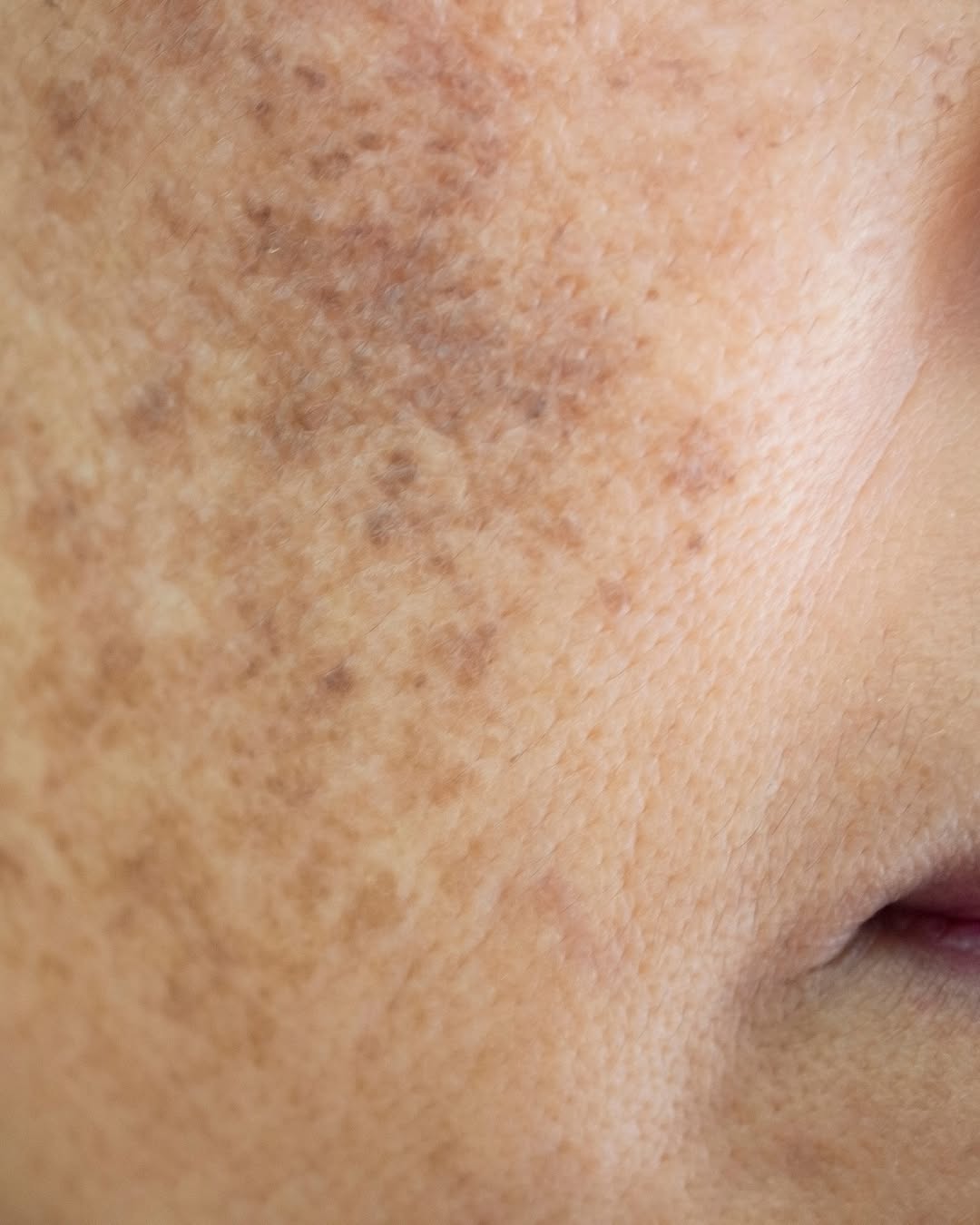 Instagram post by Dr. Eliot Battle: Hyperpigmentation is a common skin concern that causes certain areas of the face to become darker than the surrounding skin. It happens when…