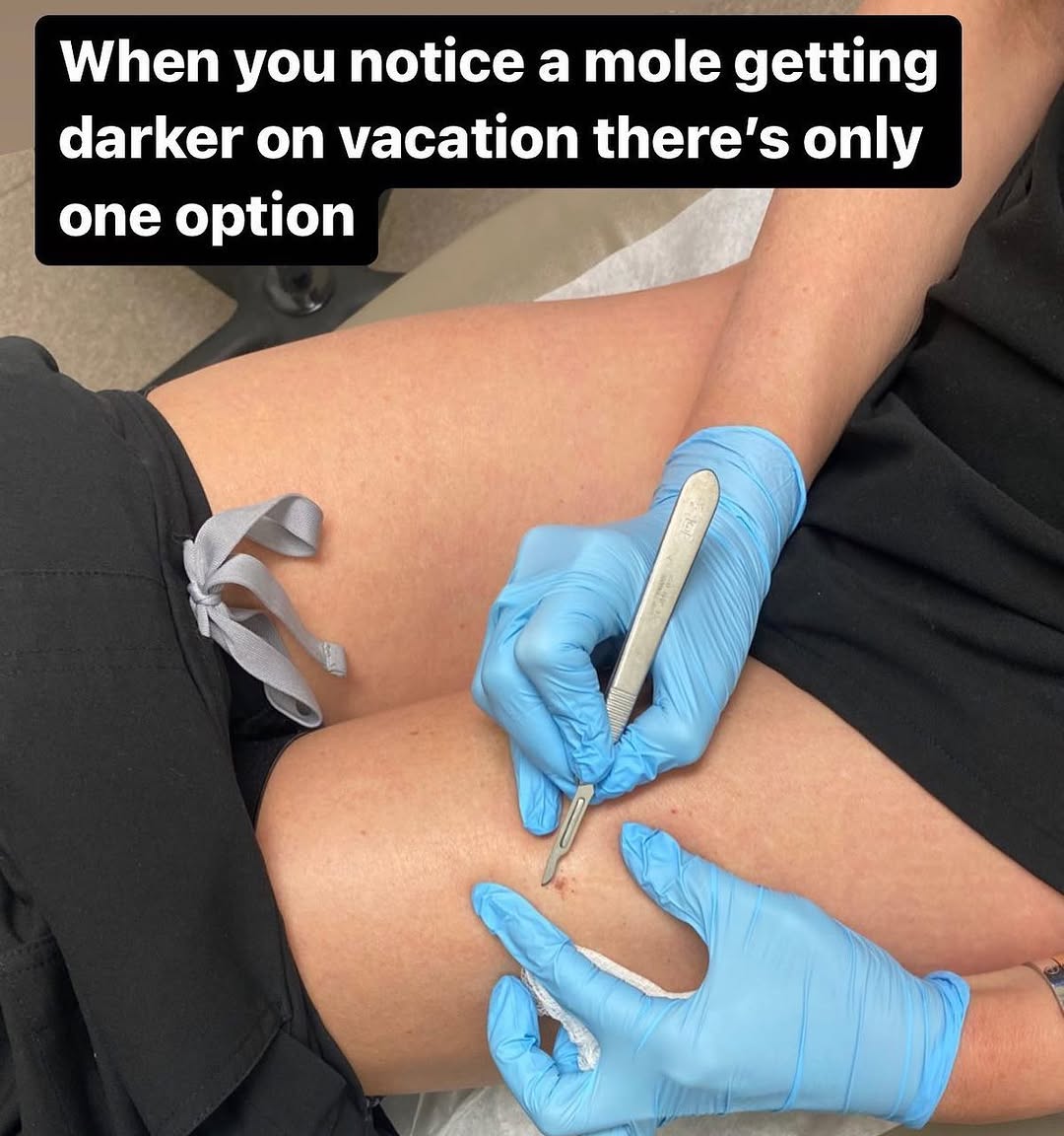 Instagram post by Dr. Elizabeth K. Hale: Biopsy thyself! This story seemed to generate a lot of interest. My biopsy showed a dysplastic nevus, but only mildly atypical, so I do not …