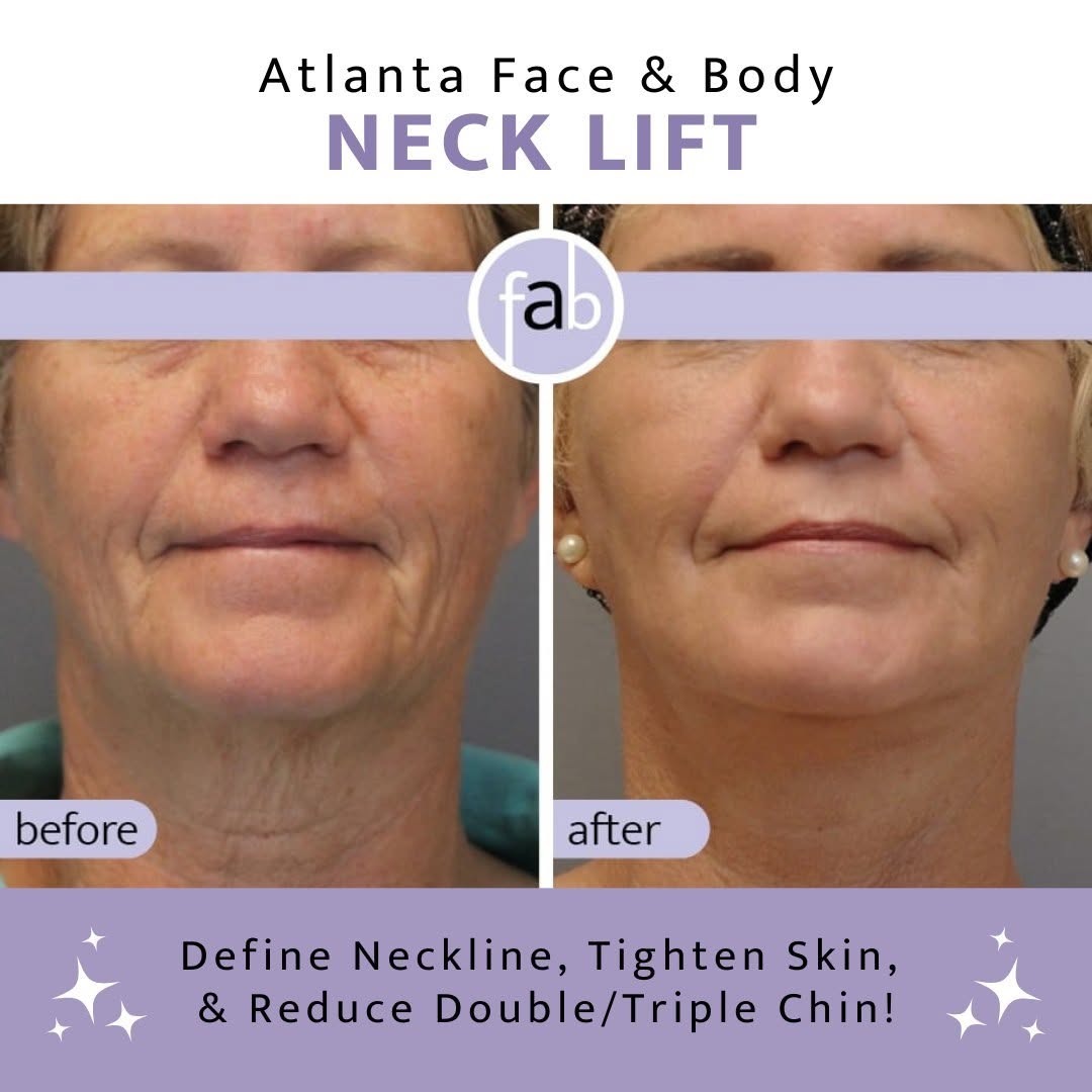 Instagram post by Dr. Elizabeth Whitaker: Check out this amazing Signature Neck Lift before and after! How does it work? Our innovative technique uses tiny, discreet incisions behind…