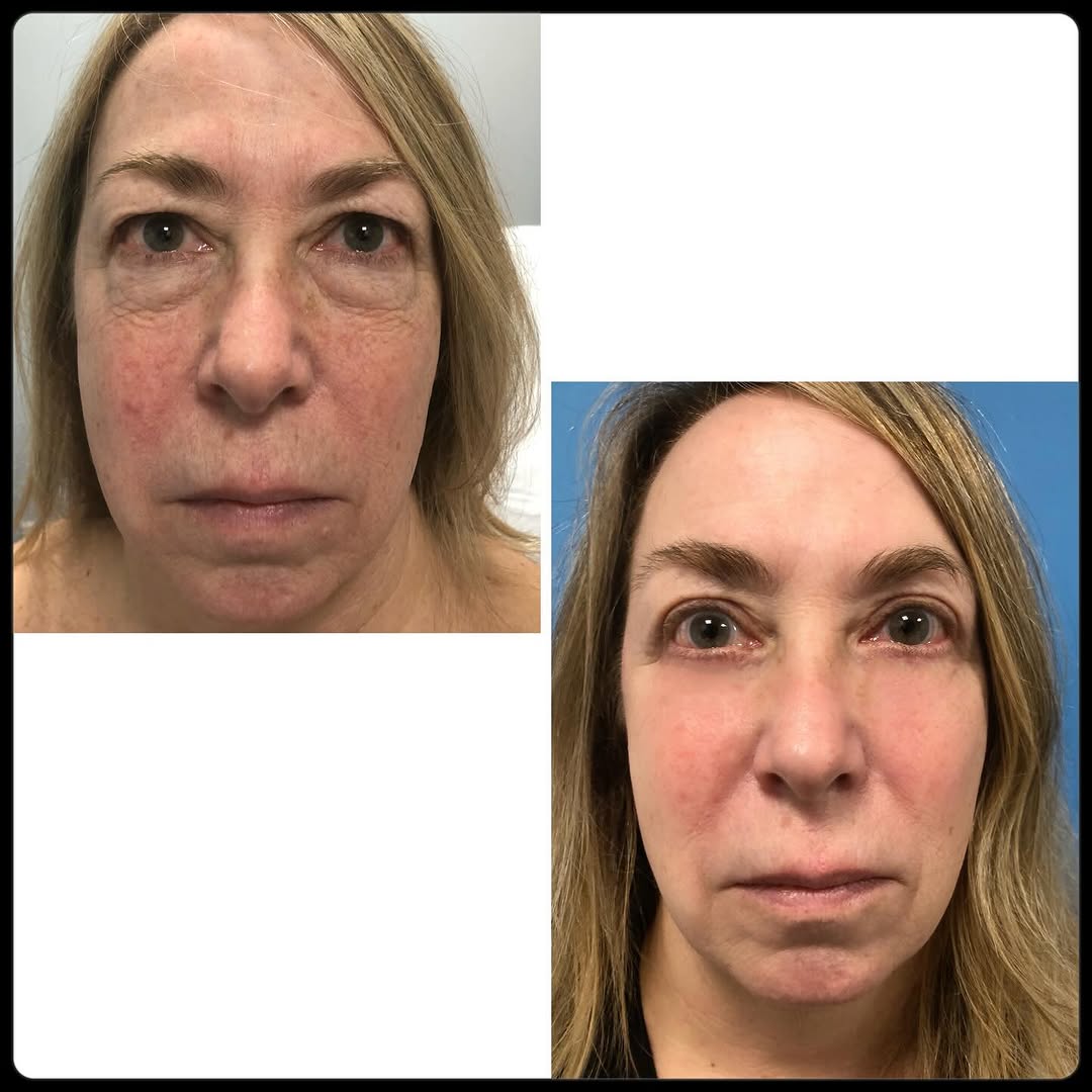 Instagram post by Dr. Elliot M. Heller: ✨4 week post upper and lower blepharoplasty✨ At this stage, most bruising has resolved and the eyes appear brighter and more rested. Final r…