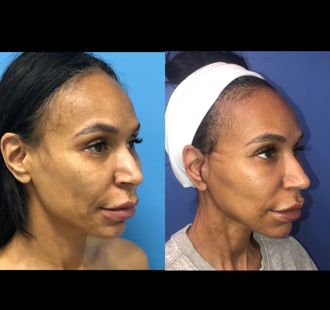 Instagram post by Dr. Elliot M. Heller: Thinking about getting a face lift ?👀💉 Take a look at this before and after one week post surgery 🤩👏🏼 interested in this surgery or ano…