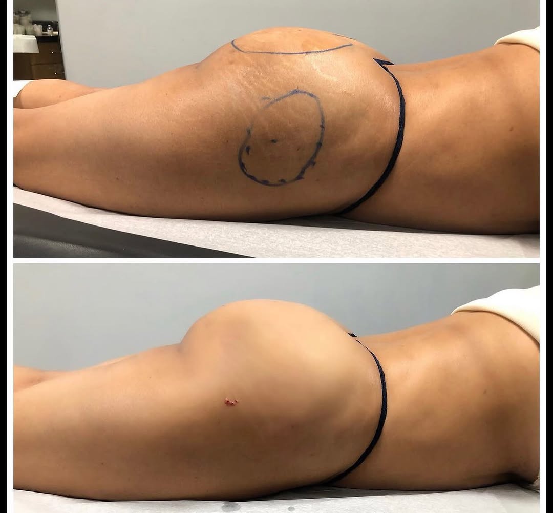 Instagram post by Dr. Elliot M. Heller: Thinking of a BBL🍑 check this out. Just a little upgrade with a Liquid BBL 💉👨🏻⚕️ Body goals start with consistency 🤗 Call us at 718-47…