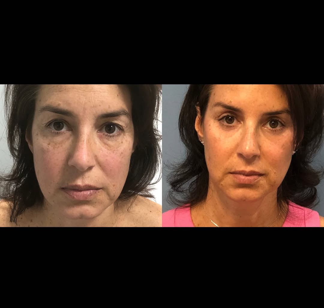 Instagram post by Dr. Elliot M. Heller: Take a look at these amazing results just THREE MONTHS later 💉🤩 Let me know what you think and this procedure is called Blepharoplasty if …