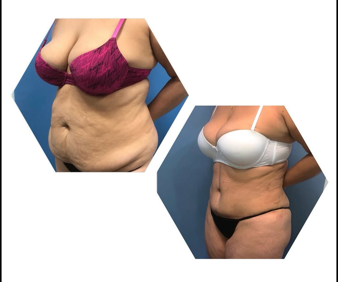 Instagram post by Dr. Elliot M. Heller: Tummy Tuck Less Than Four Months Post Surgery👏🏼🤩 At this stage swelling has significantly improved revealing a smoother more defined cont…