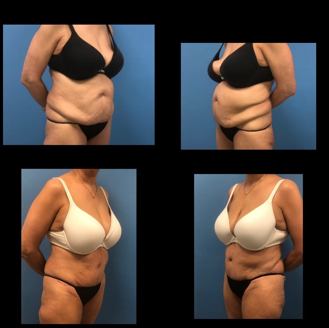 Instagram post by Dr. Elliot M. Heller: From strength to confidence 🤩 this transformation is about feeling as good as you look✨ Before and After photos of this beautiful Tummy Tuc…
