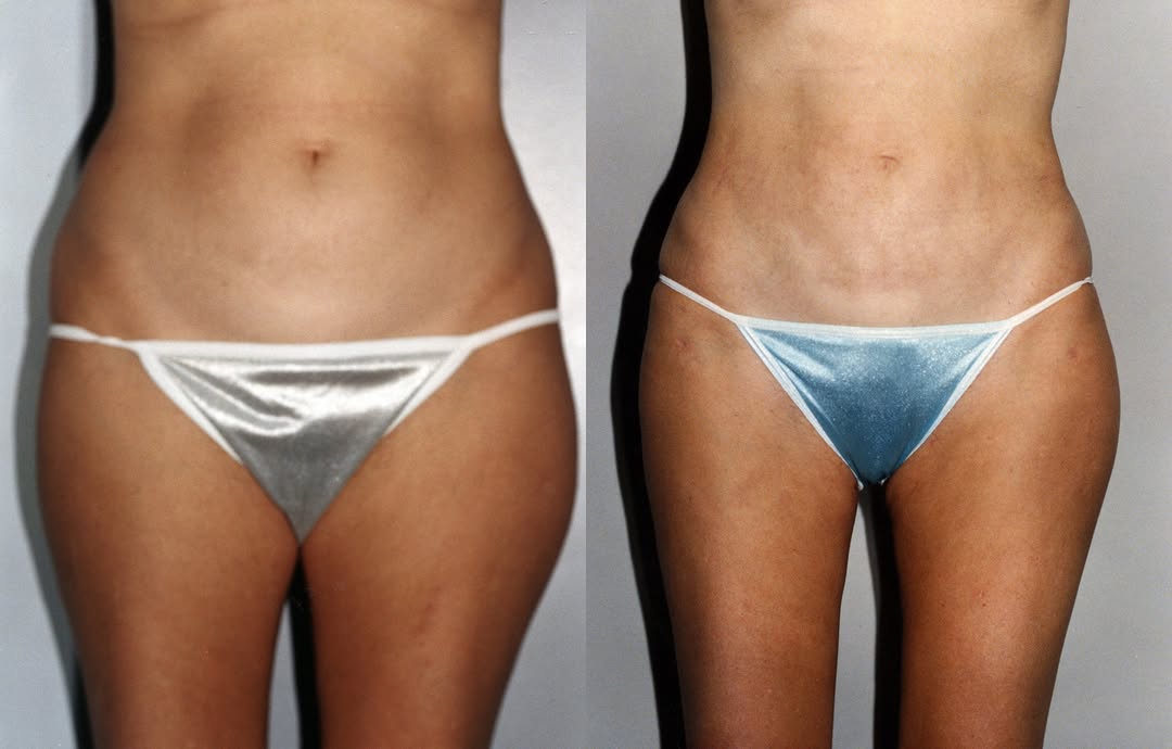 Instagram post by Dr. Elliott B. Lavey: Where subtle meets stunning. Sculpt your midsection with precision.