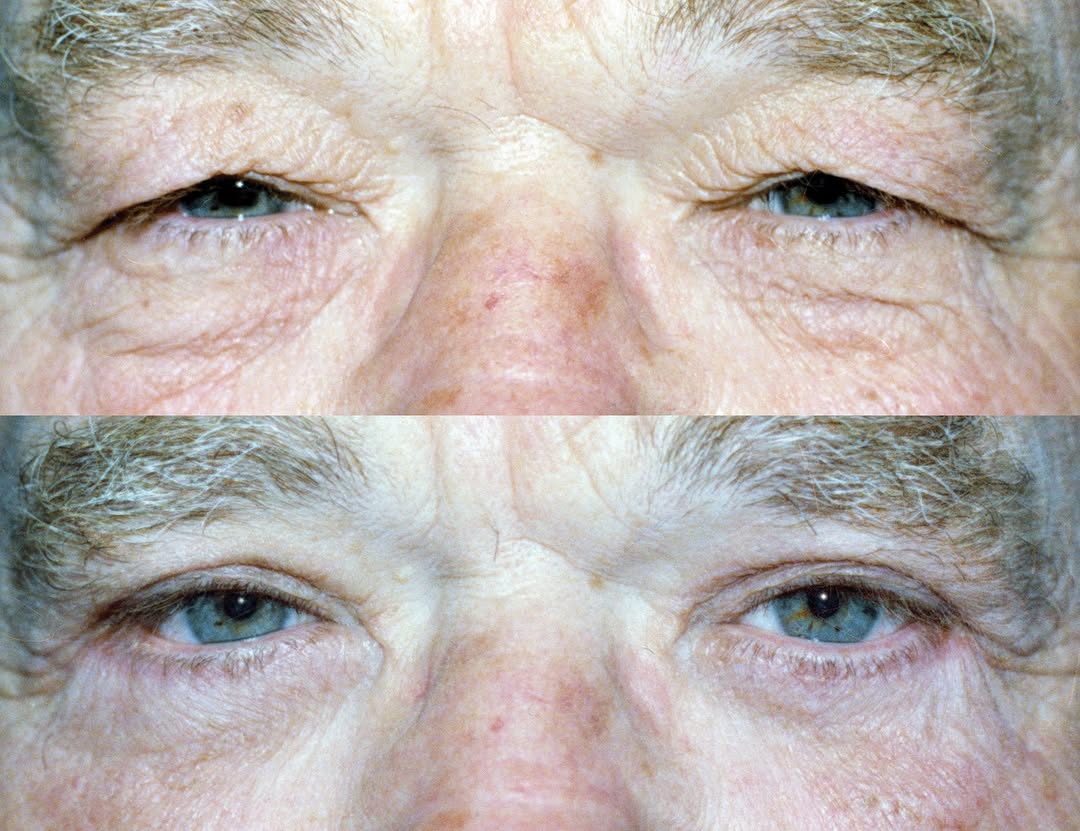 Instagram post by Dr. Elliott B. Lavey: Tired of looking tired? Blepharoplasty (eyelid surgery) can reveal a more youthful and vibrant you — no filters needed. Whether it's sagging…