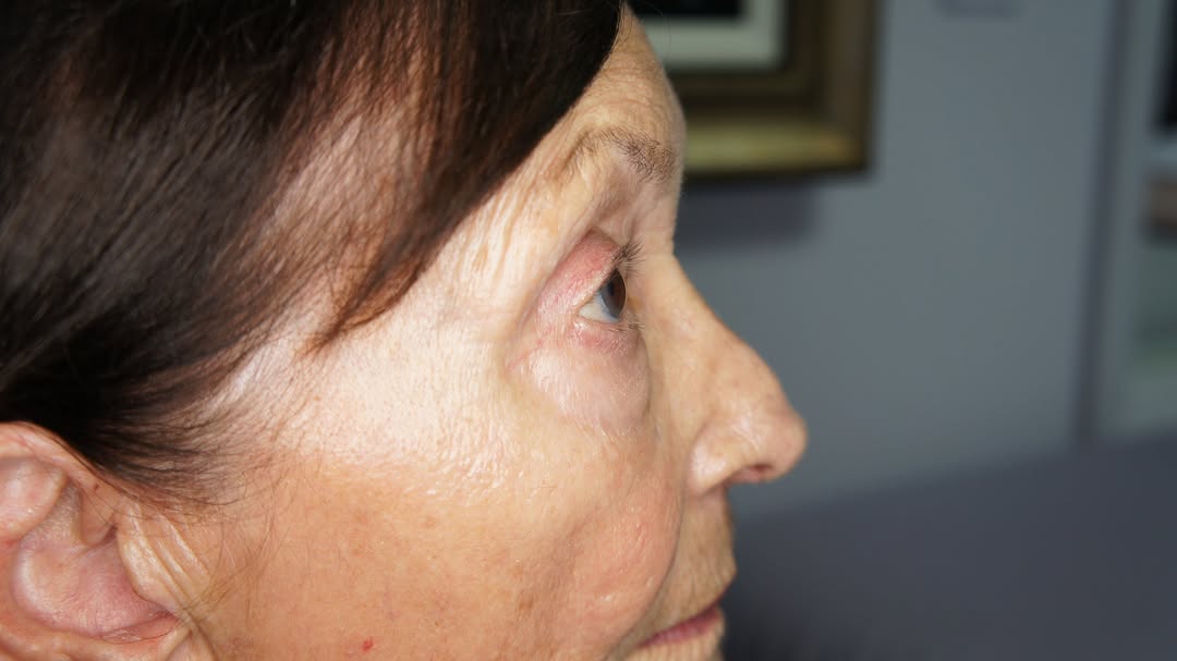 Instagram post by Dr. Elliott B. Lavey: Rhinoplasty is more than reshaping a nose—it’s refining harmony, balance, and confidence. Every result is a blend of artistry and precision,…