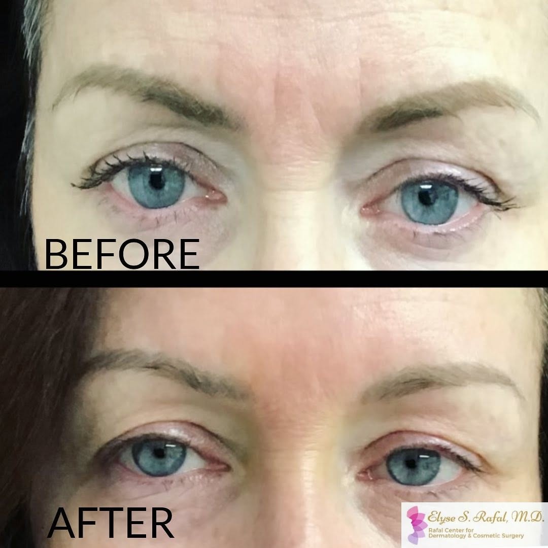 Instagram post by Dr. Elyse Rafal: The magic of Botox 💉✨ In these photos you can see my patient’s face is in a rested position and in the before photo she has some noticeable…