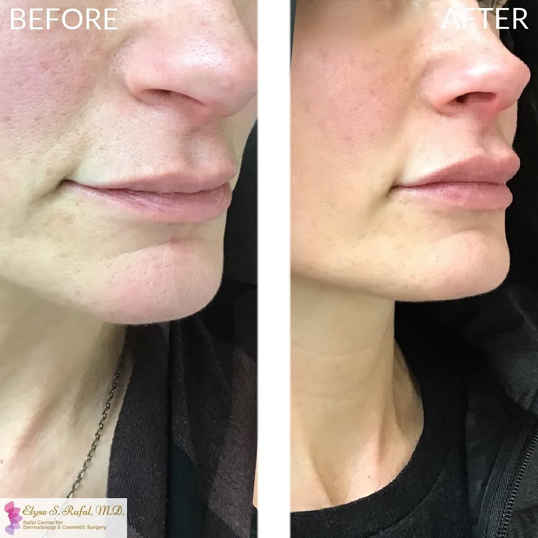 Instagram post by Dr. Elyse Rafal: Enhance your natural beauty 🦋 I’m a firm believer in the term “less is more” and my goal with my patients is to always enhance and never dr…