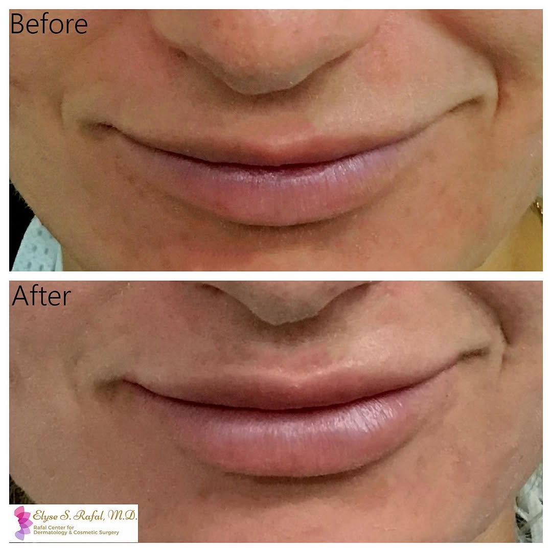 Instagram post by Dr. Elyse Rafal: Make your lips 💥POP💥 this summer! Summer is just getting started and we’re here to make you look fabulous! This patient wanted fuller lips…