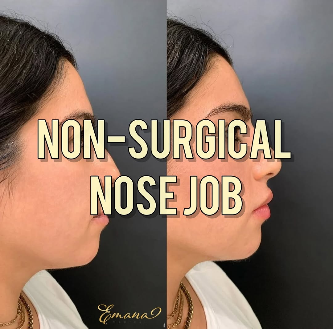 Instagram post by Dr. Eman Abdallah, DO: Non-surgical Nose Job 💉 Beautiful and natural results! I lifted and refined the tip, and balanced her bridge to create a perfect slope all …
