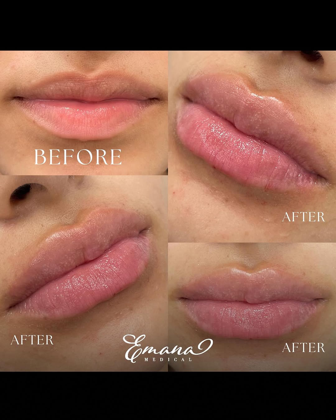 Instagram post by Dr. Eman Abdallah, DO: A little filler goes a long way! 😍 First timer? Even 0.5 of a syringe can give your lips that juicy, plump look without overdoing it... If …