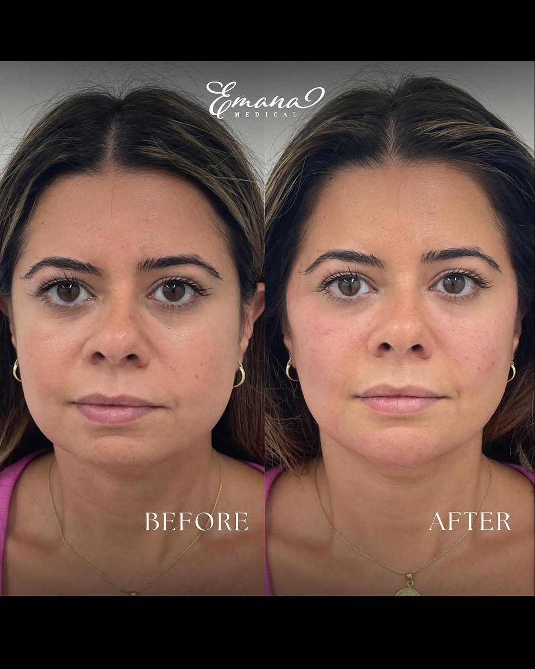 Instagram post by Dr. Eman Abdallah, DO: My Emana-Lift Full Face Balancing cases over the years. My goal isn’t to “change” your face - it’s about looking natural, lifted, and refres…
