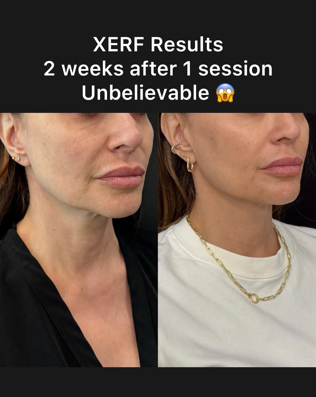 Instagram post by Dr. Eman Abdallah, DO: Our 1st XERF Patient! Look at this result. Swipe for another angle. Totally incredible. Results speak for themselves. Book yours now. Call o…