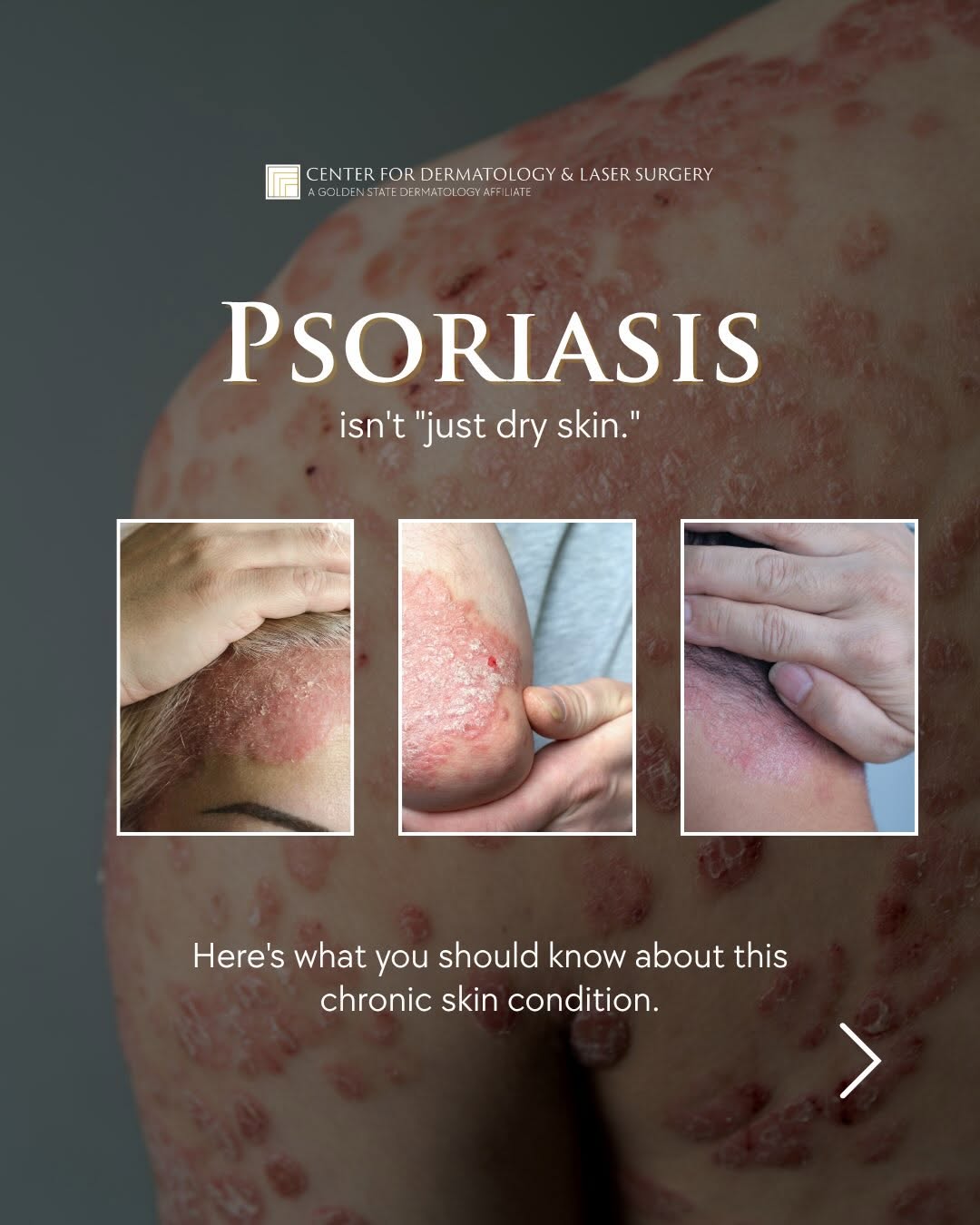 Instagram post by Dr. Emil A. Tanghetti: Psoriasis is not just dry skin. Here is what you should actually know 👉 It is one of the most misunderstood skin conditions out there and m…