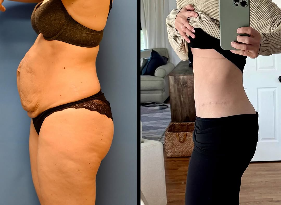 Instagram post by Dr. Emile Brown: ✨ Two years later and her results still take our breath away ✨ This 38-year-old mom of five — including triplets! — is overjoyed with her fl…