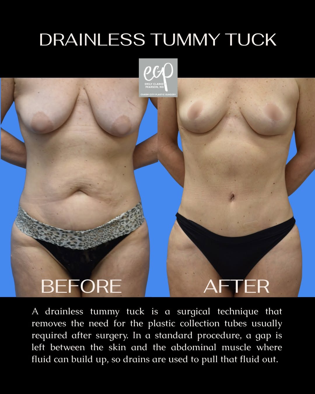 Instagram post by Dr. Emile Brown: Skip the drains, not the results ✨ A drainless tummy tuck uses advanced “quilting” sutures to secure the skin to the muscle – eliminating th…