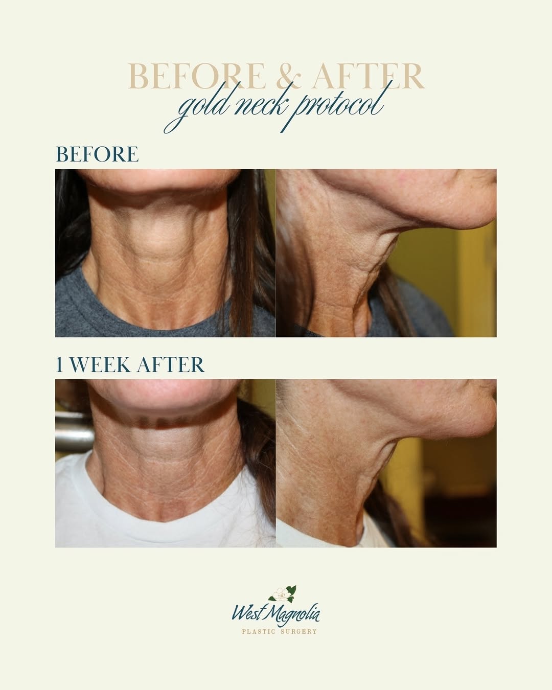 Instagram post by Dr. Emily B. McLaughlin: The Gold Neck Protocol in action. ✨ By combining Radiesse®, Belotero® and Xeomin®, this non-surgical treatment helps smooth neck lines, impr…