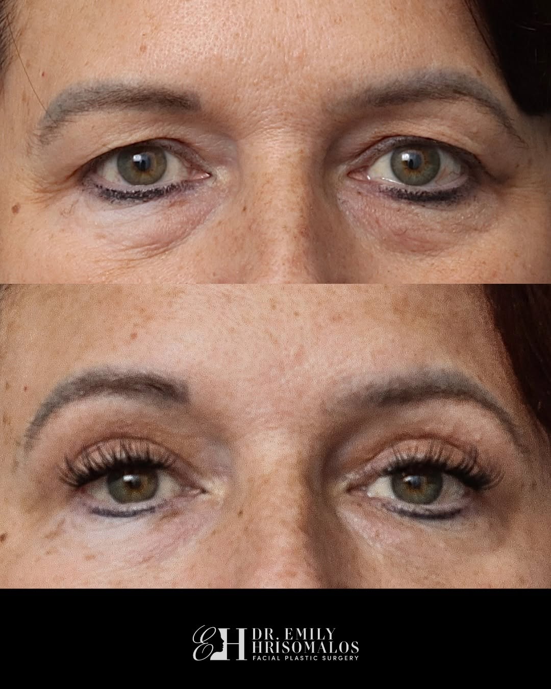Instagram post by Dr. Emily Hrisomalos: Surgical or non-surgical? Sometimes the answer is both. For this patient, we combined an upper blepharoplasty with carefully placed lower ey…