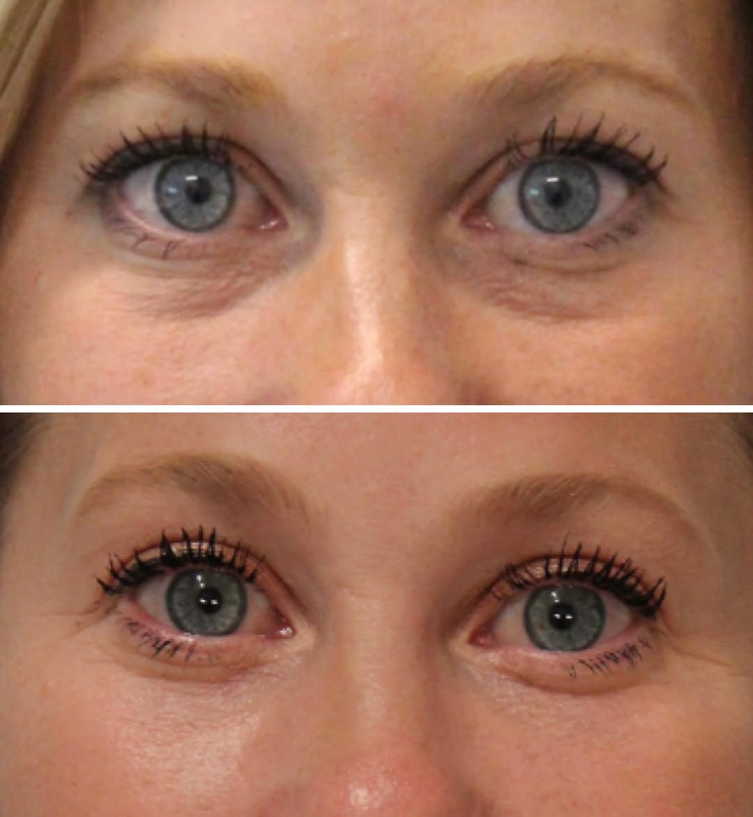 Instagram post by Dr. Emily M. Bratton: ✨✨ Natural and Refreshed✨✨ My sweet patient who wanted to look natural but felt she needed a refresh! I performed an upper blepharoplasty an…
