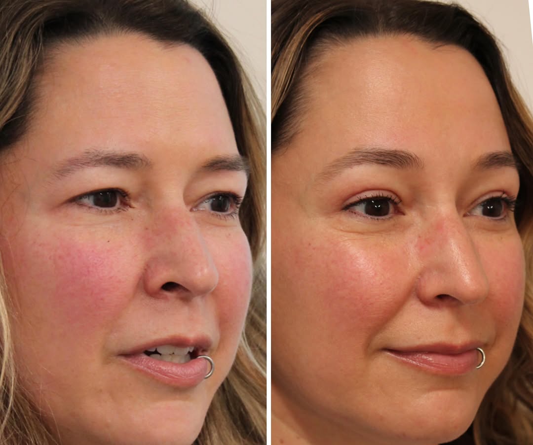 Instagram post by Dr. Emily M. Bratton: ✨Endoscopic Brow Lift and Upper Blepharoplasty✨ together make the best picture for some patients. It’s always a discussion about what an iso…